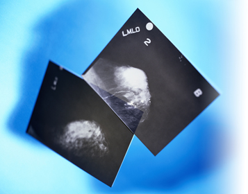 icr_mammogram_ar